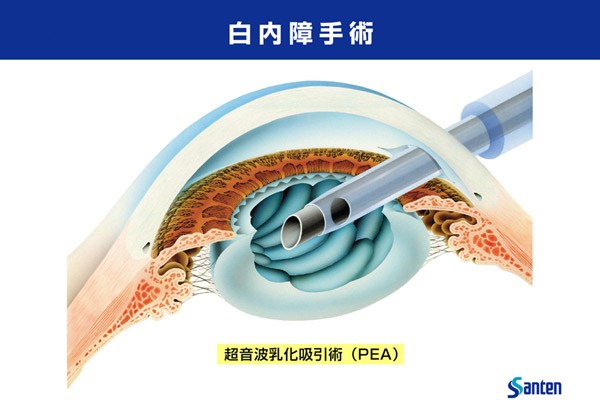 白内障手術について