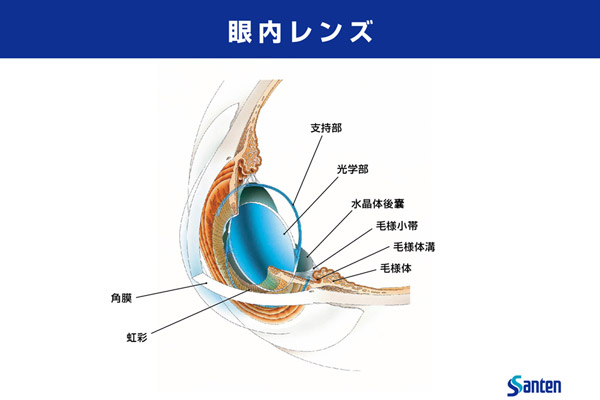 眼内レンズ